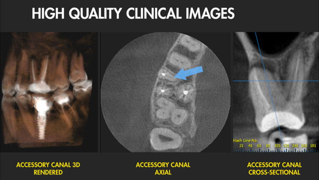 Images accesory canal 3D Axial / Cross sectional