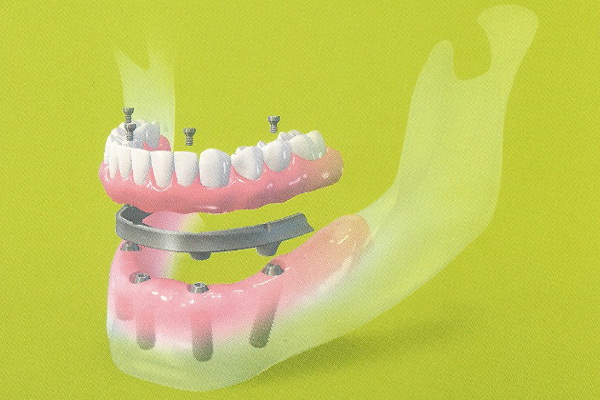Image Dental implants Clínica Dental Moraira