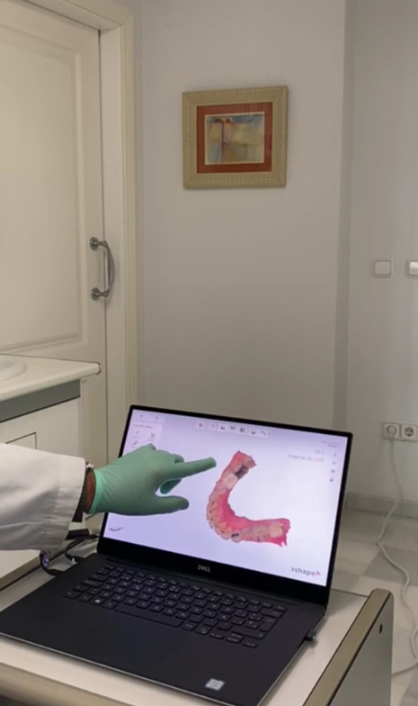 Intraoral Dental Scanner at Moraira Dental Clinic