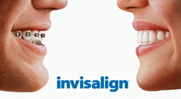Image Invisalign or Invisaling Clínica Dental Moraira